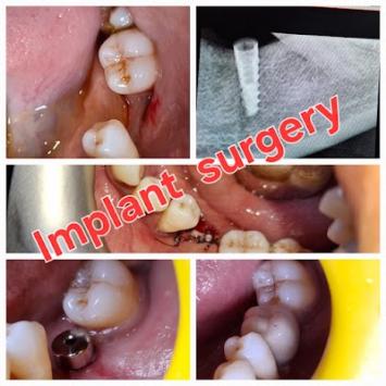 DENT9N7YTE8W_Usha_Dental_Clinic___Implant_centre_ChIJzcOEzygb8jkRWEZDfzg2d5U_5
